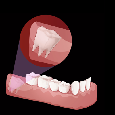 Wisdom Teeth Holes Fundamentals Explained